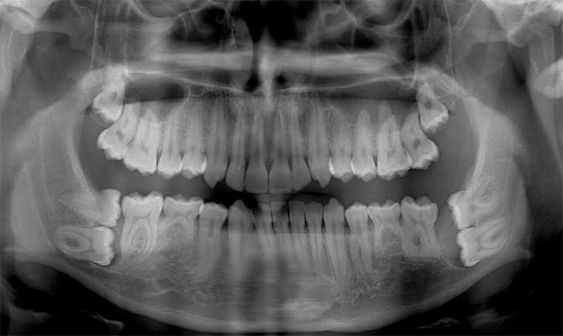 Ретинований зуб