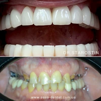 Зуби до та після