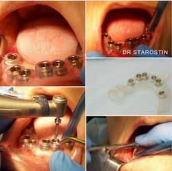Імплантація зубів нижньої щелепи