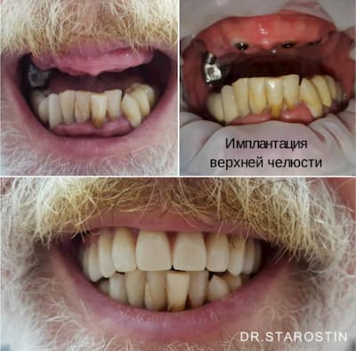 Отсутствие зубов на верхней челюсти