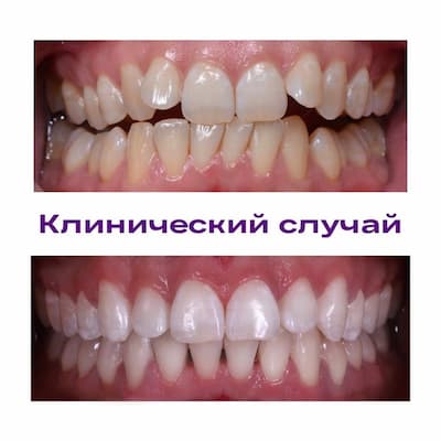 Вирівнювання зубів