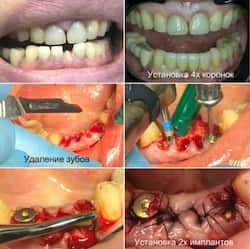 Наявність грануляцій. Видалення зубів та одномоментна імплантація