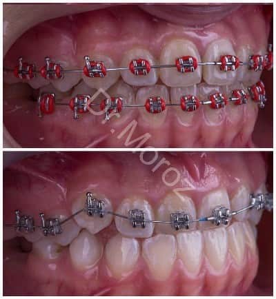 Брекет-системы на зубы