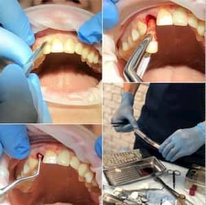 Видалення переднього зуба