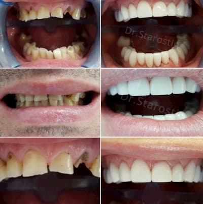 терапевтическая подготовка зубов
