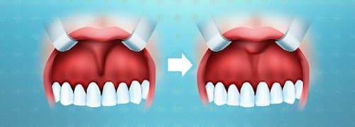 Фото до и после пластики уздечки губы