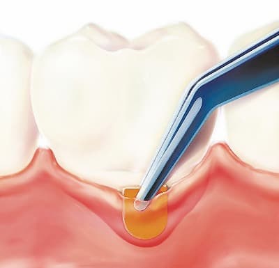 Лечение в стоматологии киева периочипом