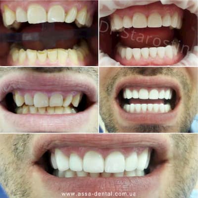 Підняття прикусу на 5 мм, відновлення всіх груп зубів