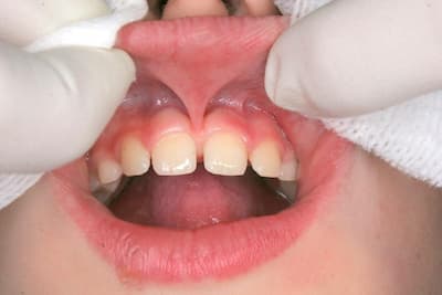 Короткая уздечка губы: признаки и исправление | Colgate®