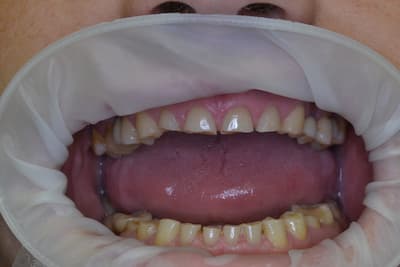 Истираемость зубов