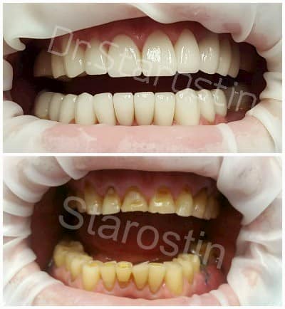 Стираемость зубов и исправление