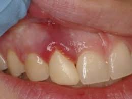 Отек после удаления зуба - причины, когда пройдет, как снять