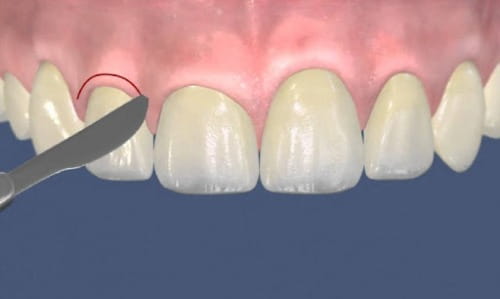 Пластика ясен стоматологія асса