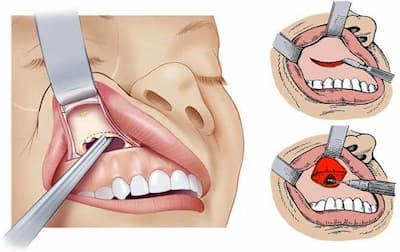 Лечение кисты зуба | Стоматологическая клиника «Имплант Лаб»