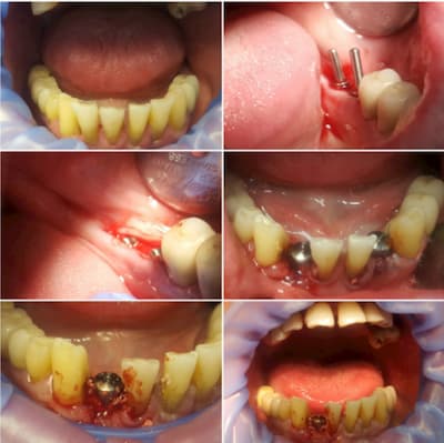 Одномоментная  имплантация зубов 