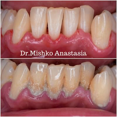 До и после чистки зубов в стоматологии асса