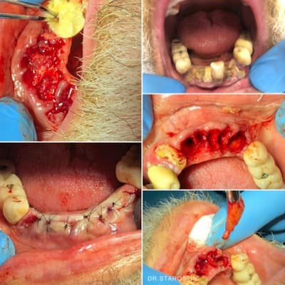 Видалення зруйнованих 8 коренів зубів