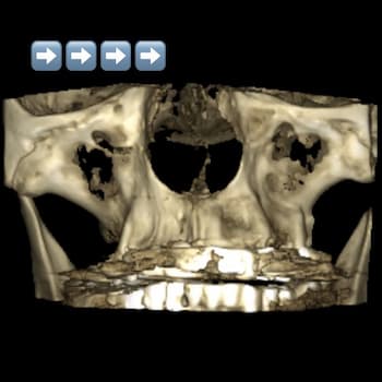 Рентгенография зубных рядов