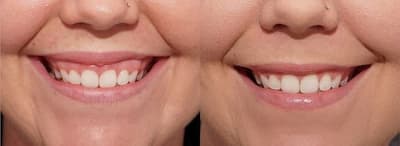 Аномалии прикрепления уздечек губ и языка — Стоматологическая поликлиника №6