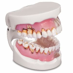 Лікування гінгівіту в стоматології