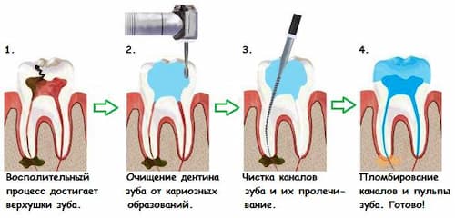 Чистка каналов зуба