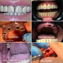 Повне видалення зубів на верхній щелепі
